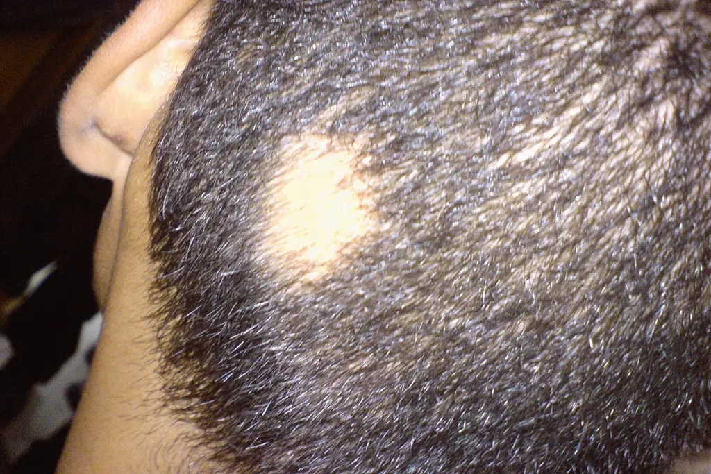 Alopecia areata.
